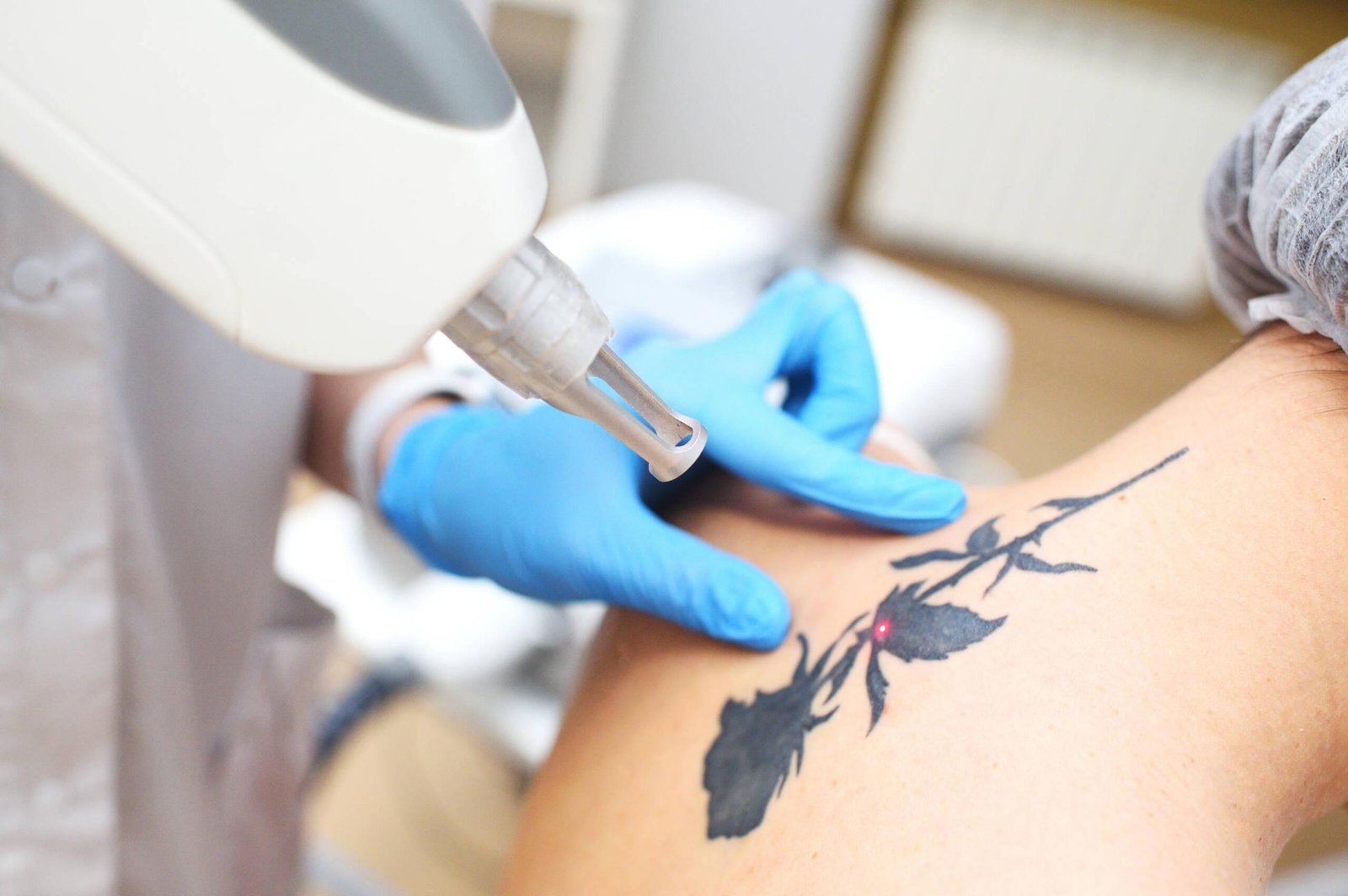 How Laser Tattoo Removal Improves Skin Appearance