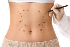 Liposuction Dubai