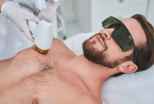 How Many Sessions for Men’s Laser Hair Removal Success