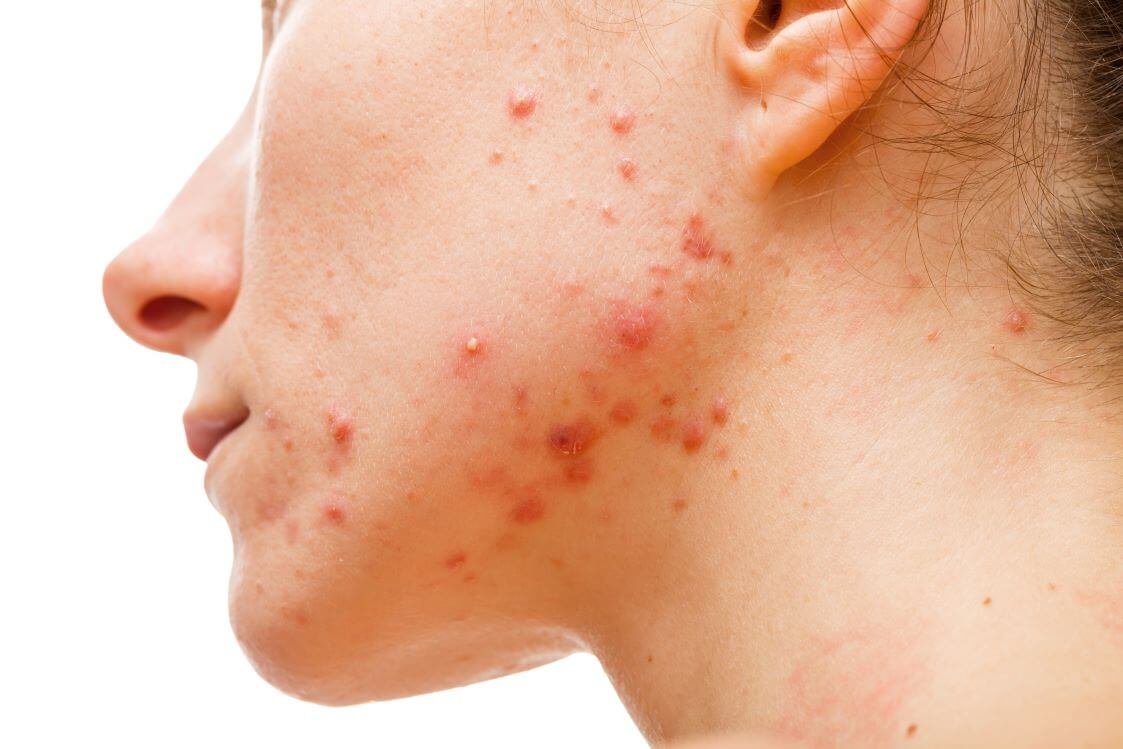 Is Acne Treatment More Effective Than Home Remedies?