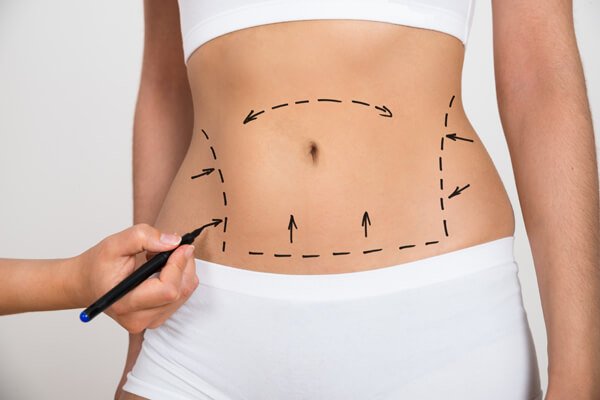 Is Liposuction Surgery Safe for Both Men & Women?