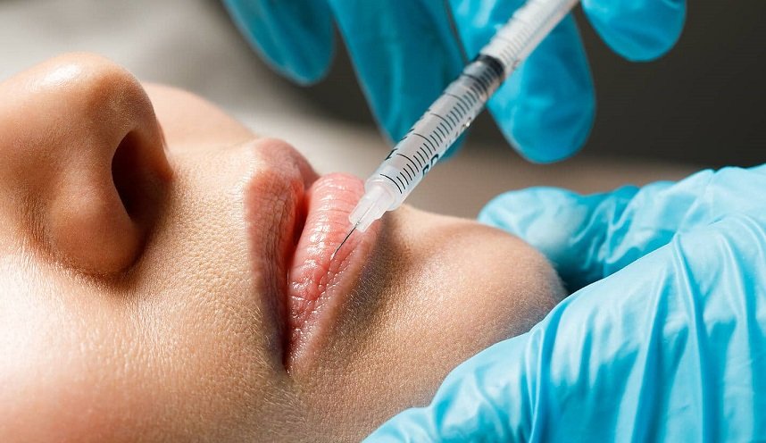 Lip Botox That Might Be Worth the Hype