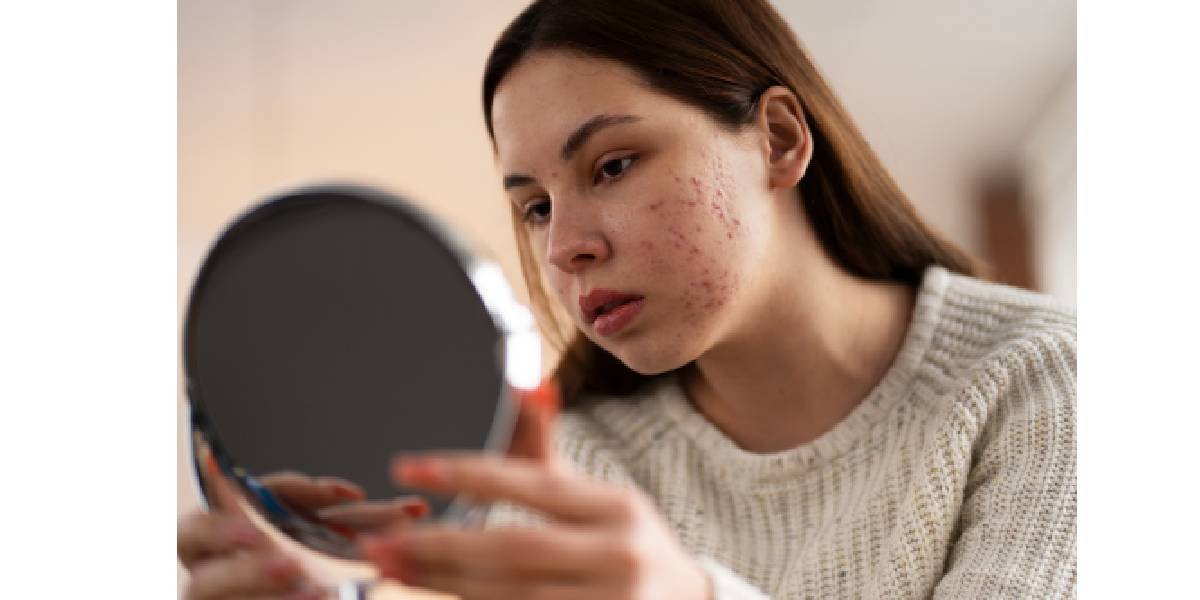 acne prone skin care