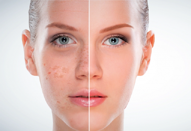 Pigmentation Treatment: Combining Therapies for Best Results