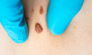 Remove Skin Tags on the Inner Thigh: You Need to Know First