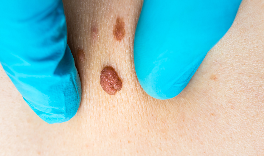 Remove Skin Tags on the Inner Thigh: You Need to Know First