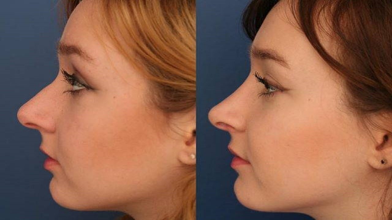 عملية تجميل الأنف في الرياض