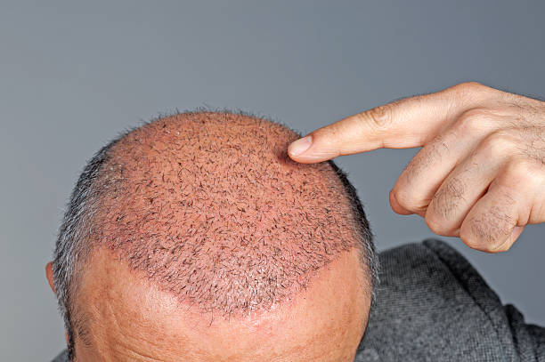 Scalp Micropigmentation in Dubai