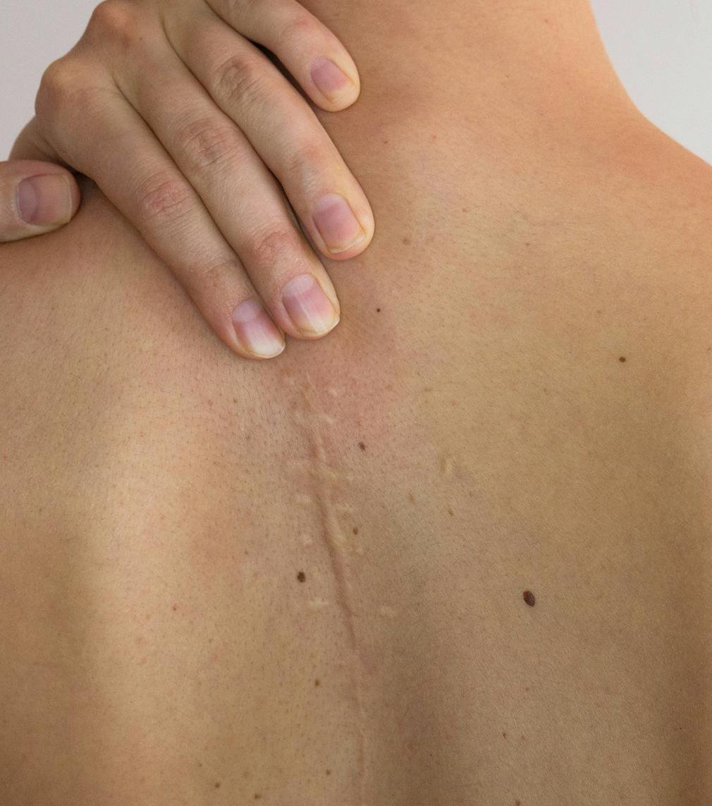 Surgical Scar Revision: A Fresh Outlook on Beauty