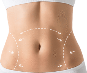 Tummy Tuck: Achieve a Sleek, Toned Midsection