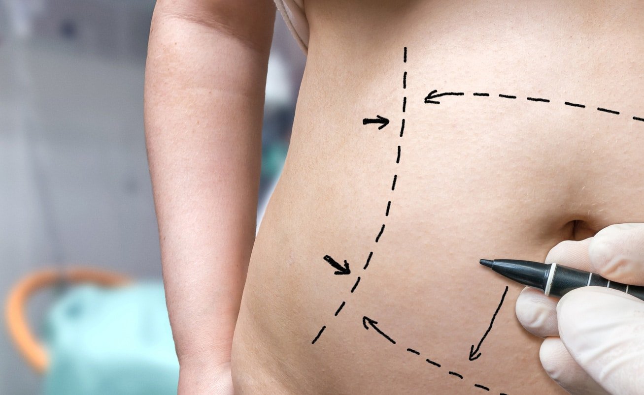 Vaser 4D Liposuction: Fat Removal for a Perfect Shape