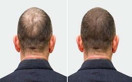 زراعة الشعر في الرياض