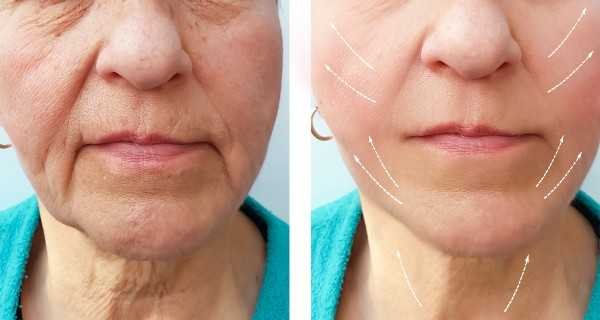 botox