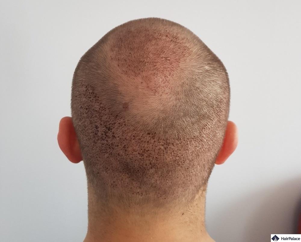 Hair Transplant in Dubai