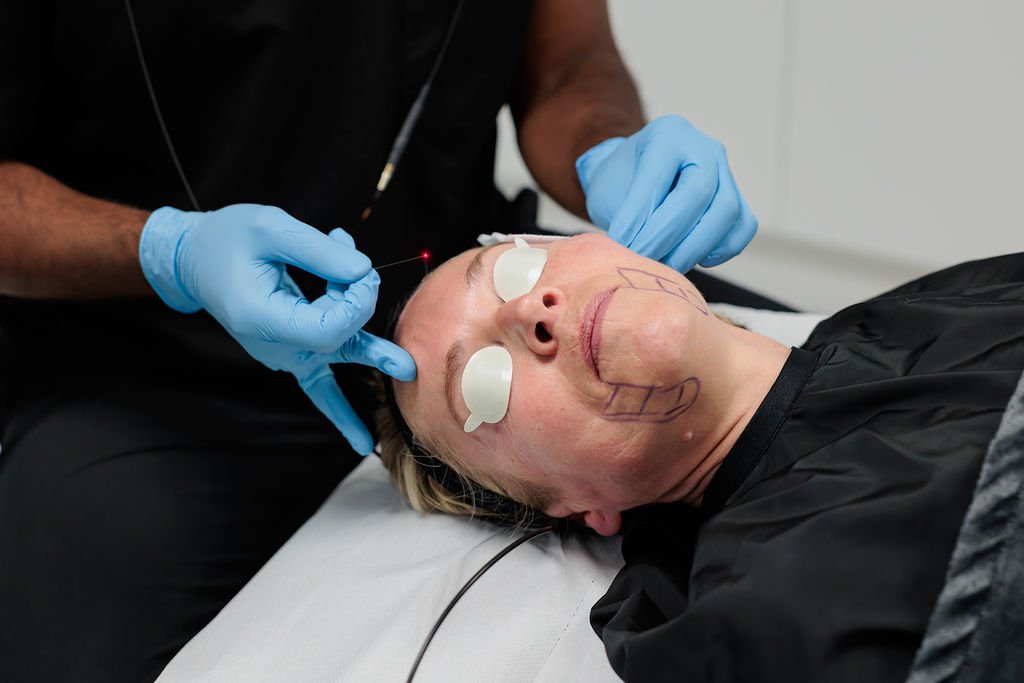 How EndoLift Reduces Double Chin Fat
