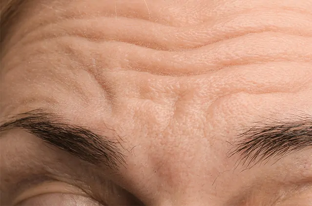 How Fast Does Wrinkle Treatment Show Results?