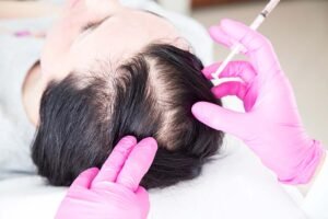 How Many PRP Hair Treatment Sessions Are Needed?