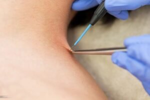 How Safe Is Warts Removal Treatment for Skin?