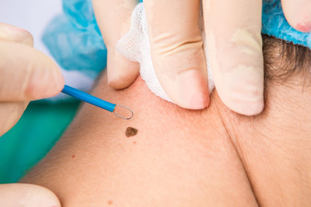 How Warts Removal Treatment Gives Smooth Skin Again