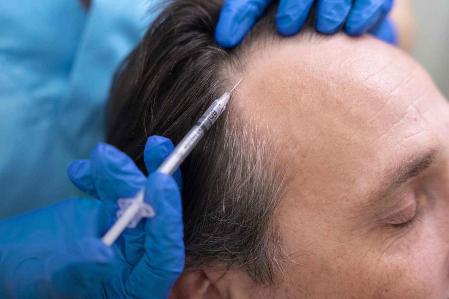Is Exosome Therapy Good for Hair Restoration