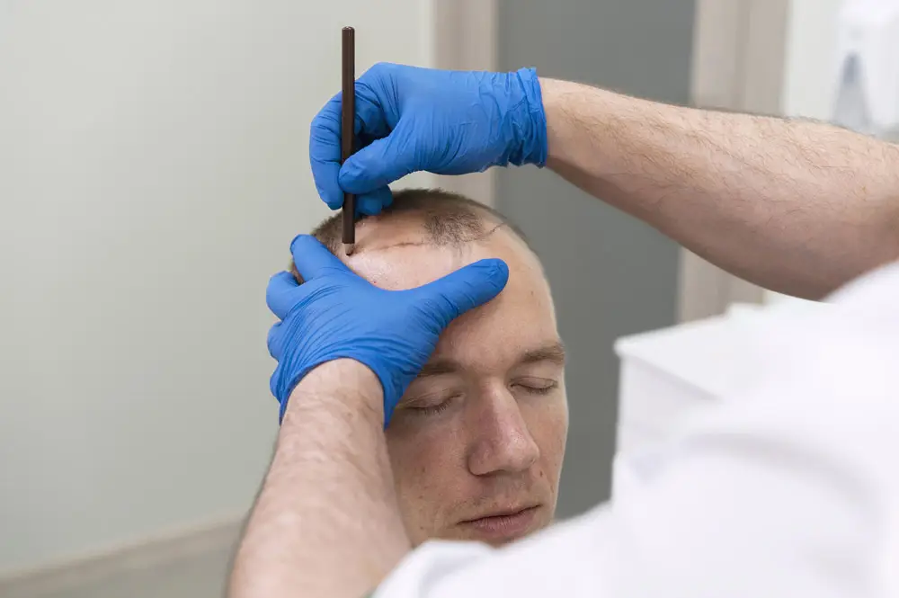 Hair Transplant in Dubai