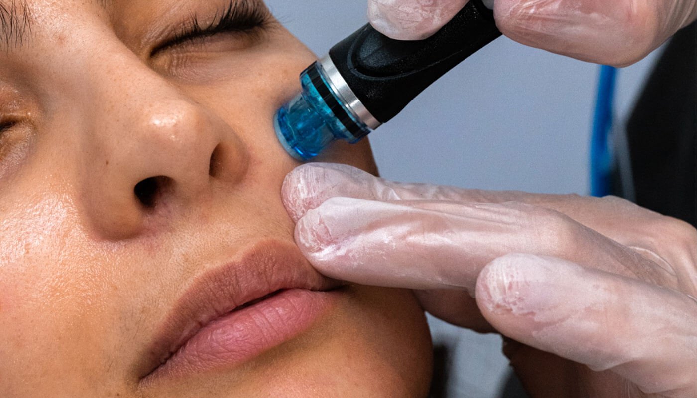 How HydraFacial Targets Stubborn Skin Concerns