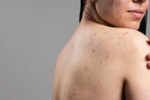 Is Skin Diseases Treatment Painless and Non-Invasive