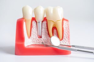 Modern Tech Enhancing Dental Implants in Dubai