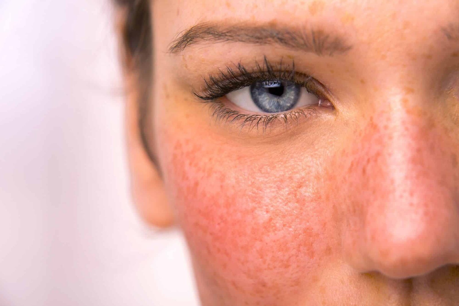 What Are the Latest Advances in Rosacea Treatment?