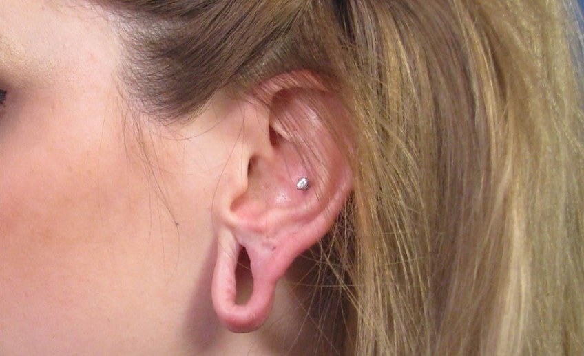 Earlobe Surgery in Dubai