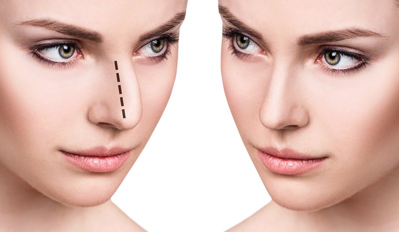 Affordable Rhinoplasty in Dubai Tips