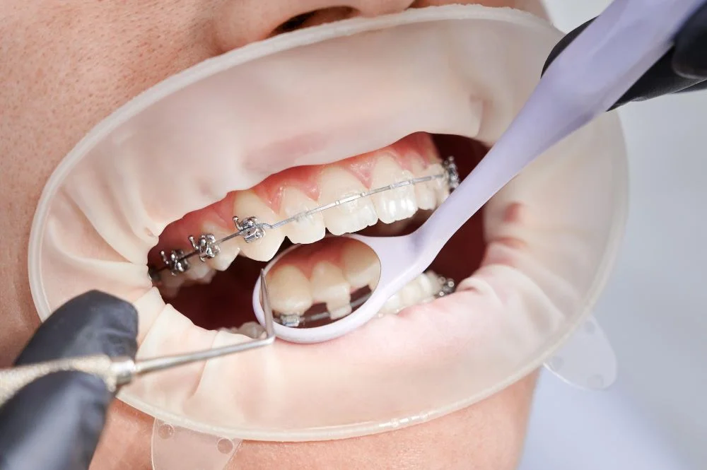Dental Braces Dubai: Comfort and Durability