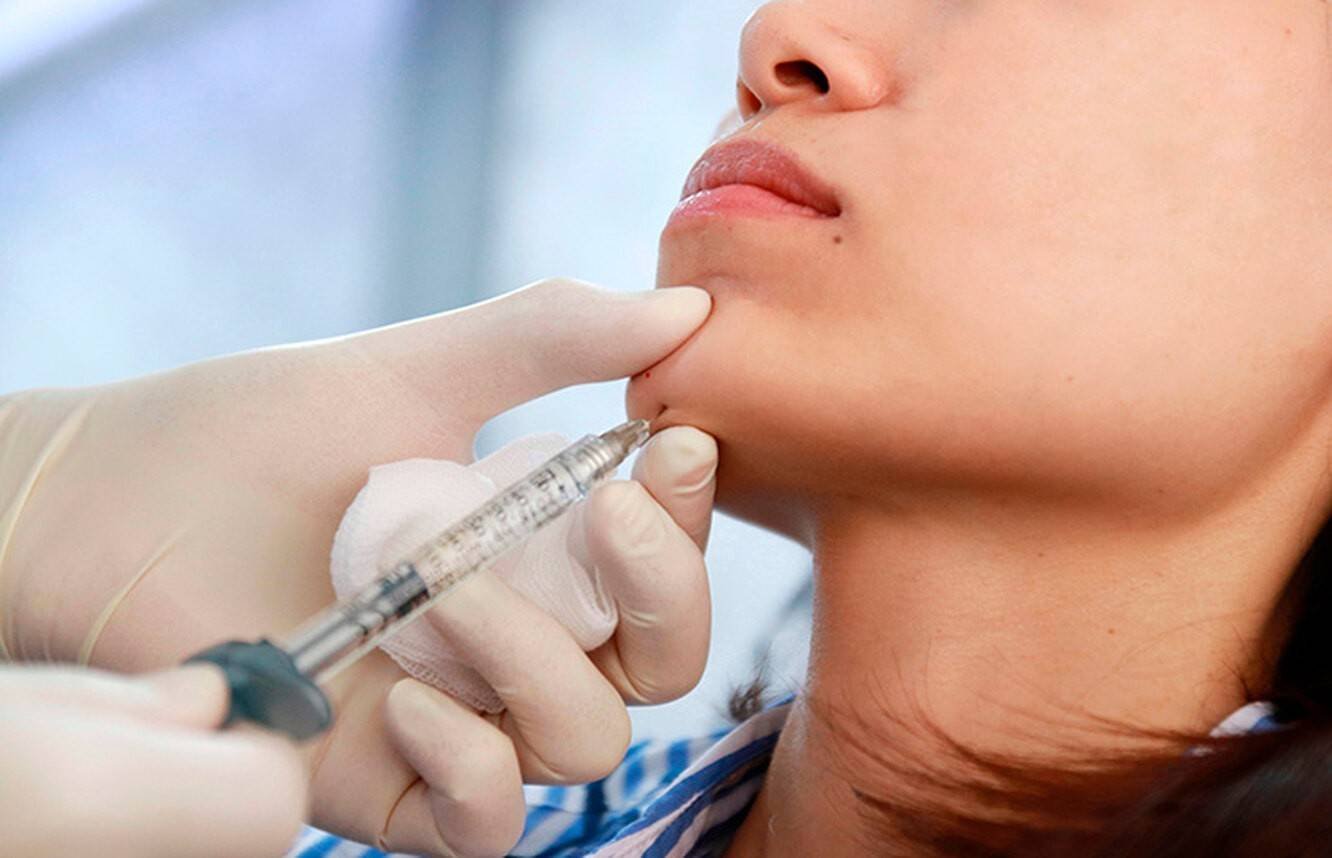 Cheek Fillers in Dubai