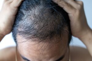 Does PRP Hair Therapy Give Permanent Results?