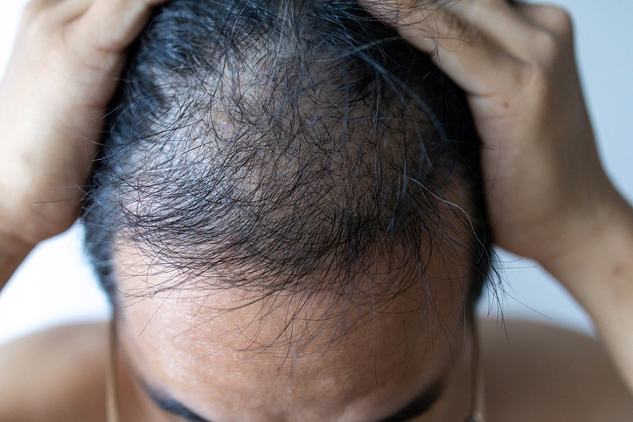 Does PRP Hair Therapy Give Permanent Results?
