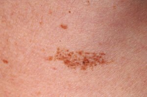 Dubai Laser Mole Removal: Expert-Approved Clinics