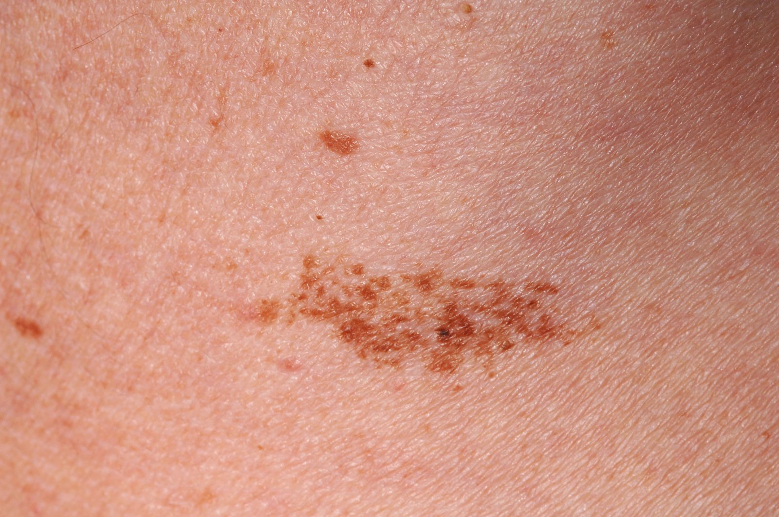Dubai Laser Mole Removal: Expert-Approved Clinics
