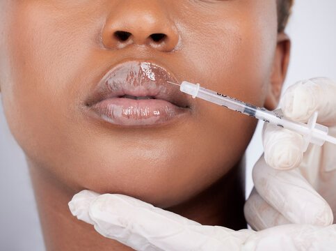 Lip Fillers in Dubai