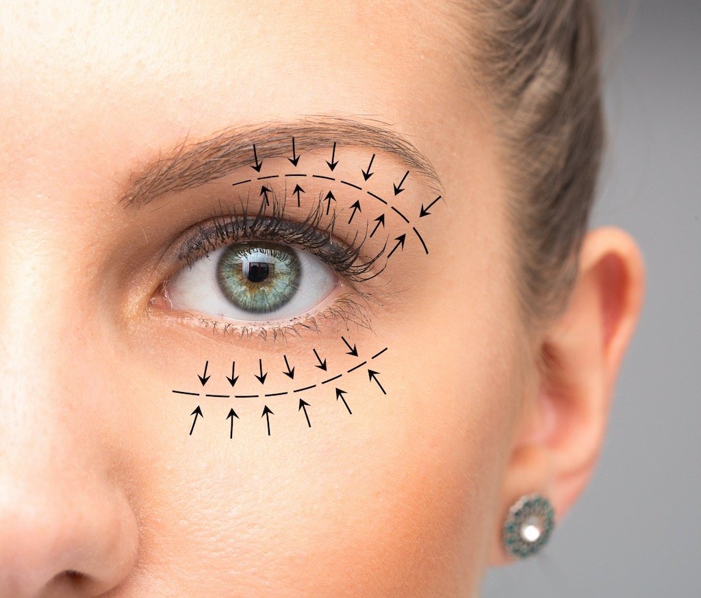 Blepharoplasty Dubai