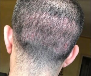 Hair Transplantation: Dubai Experts Share Top Tips