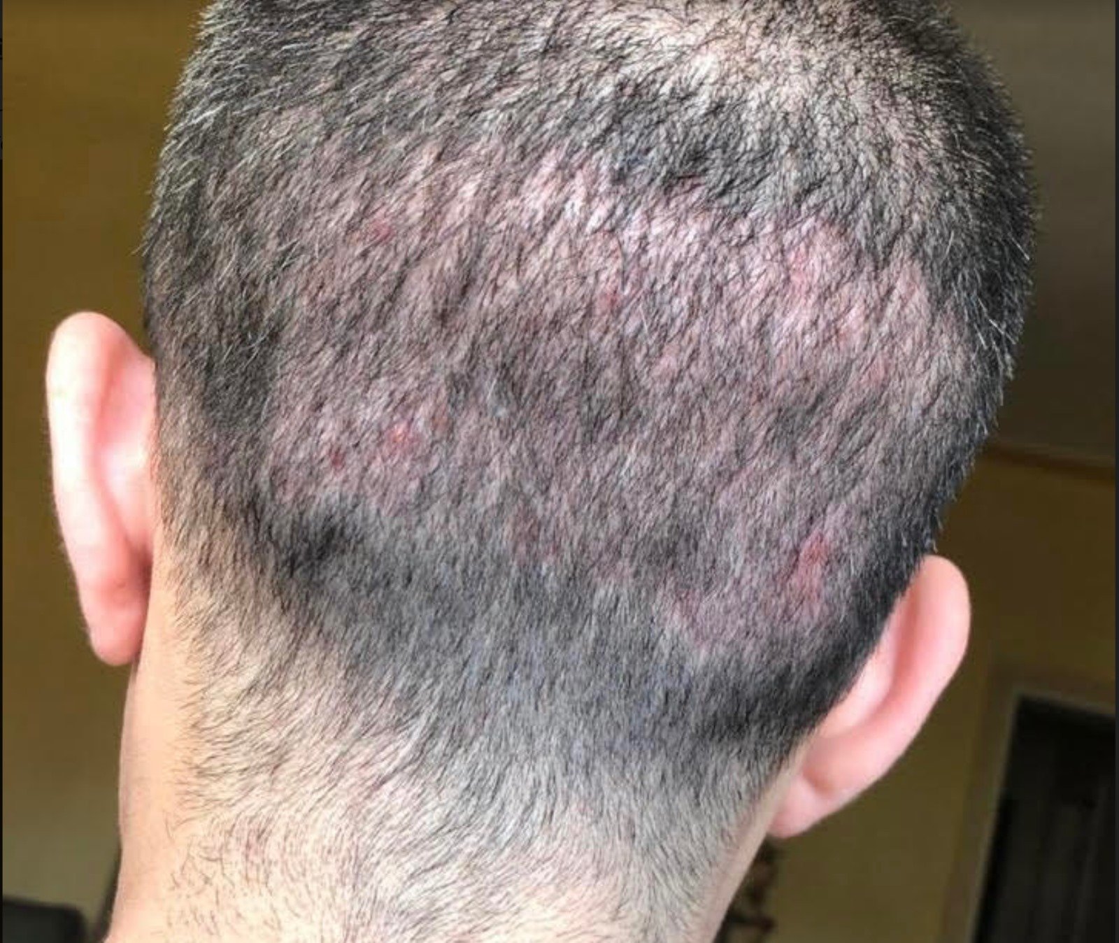 Hair Transplantation: Dubai Experts Share Top Tips