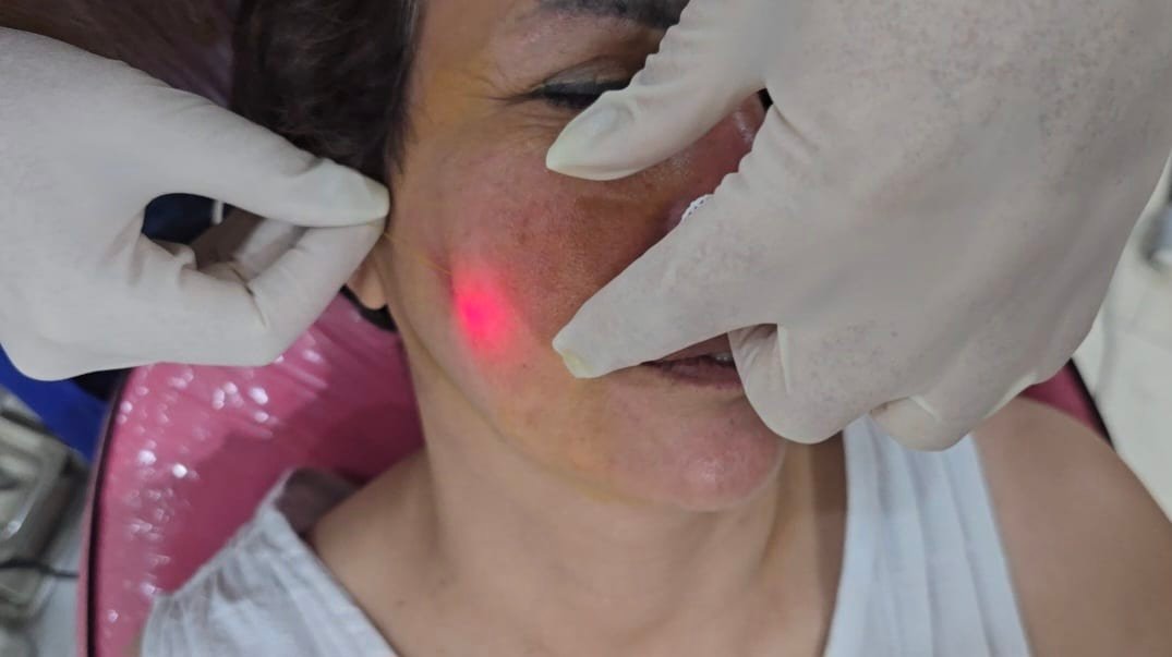 How Long Does Endolift Last on the Face and Neck