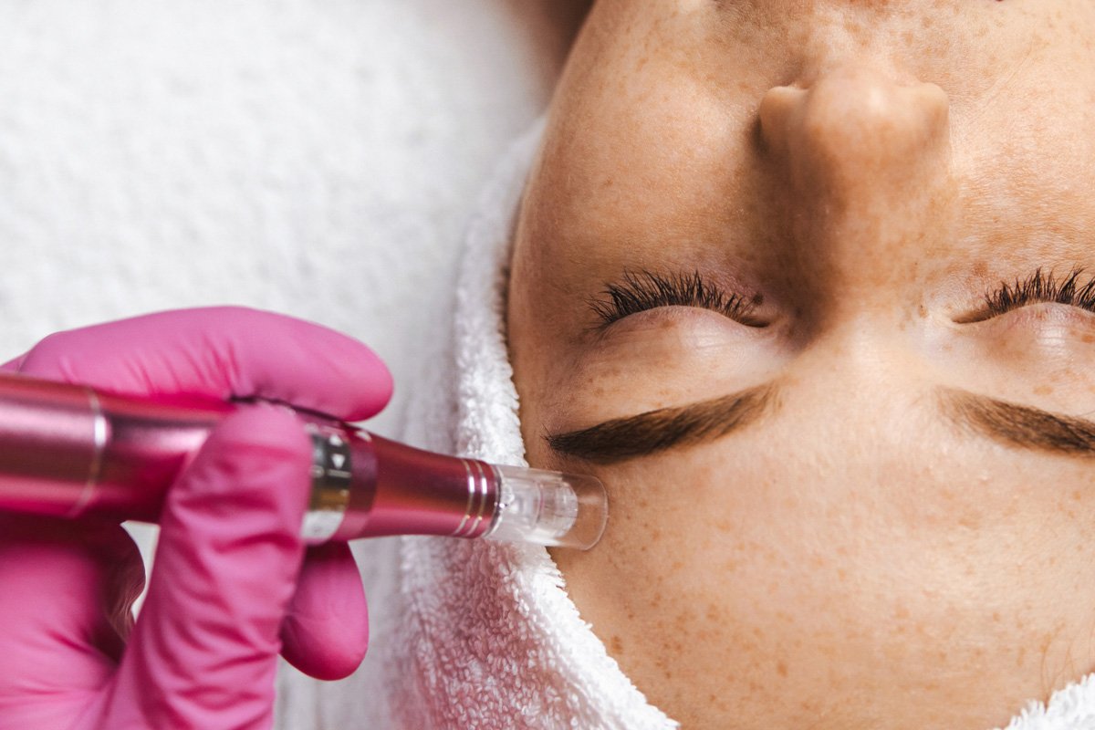 Is Dermapen Treatment Safe for All Skin Types?