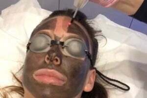 Is Laser Carbon Peel Safe for Darker Skin Complexions?