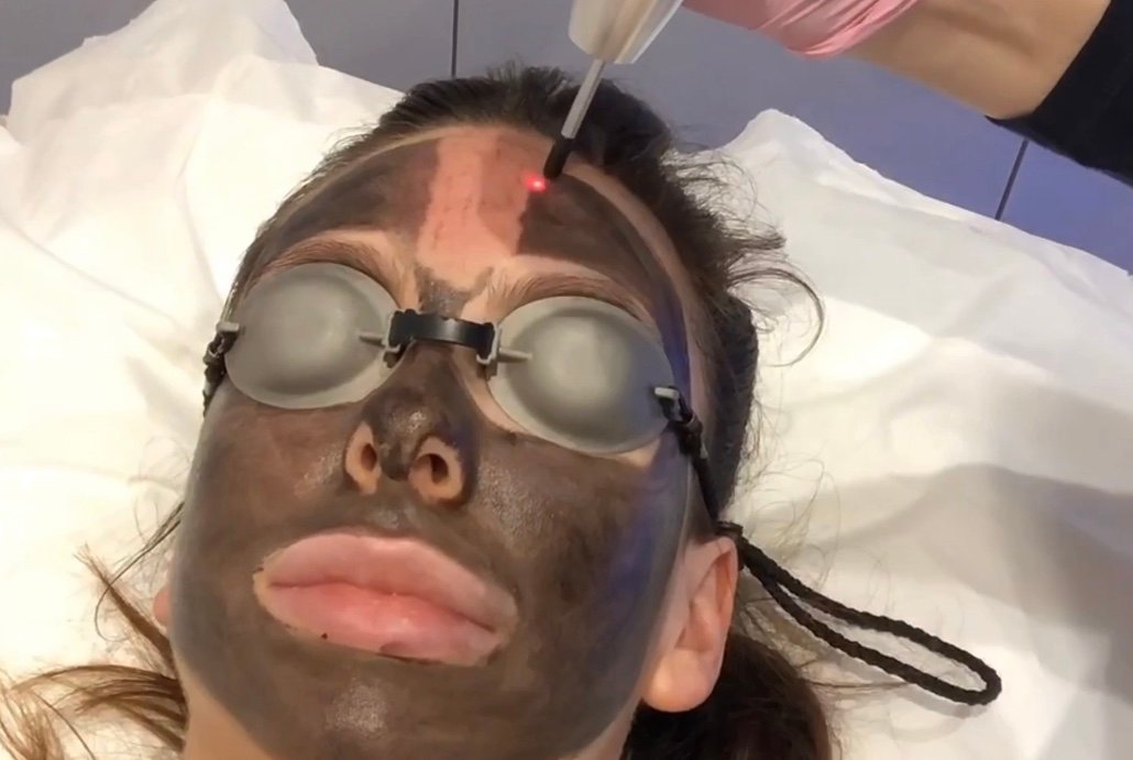 Is Laser Carbon Peel Safe for Darker Skin Complexions?