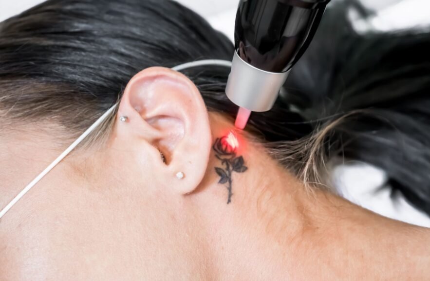Laser Tattoo Removal for Fading Old Tattoos
