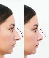 جراحة تجميل الأنف