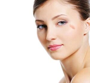 Tips for Faster Birthmark Healing