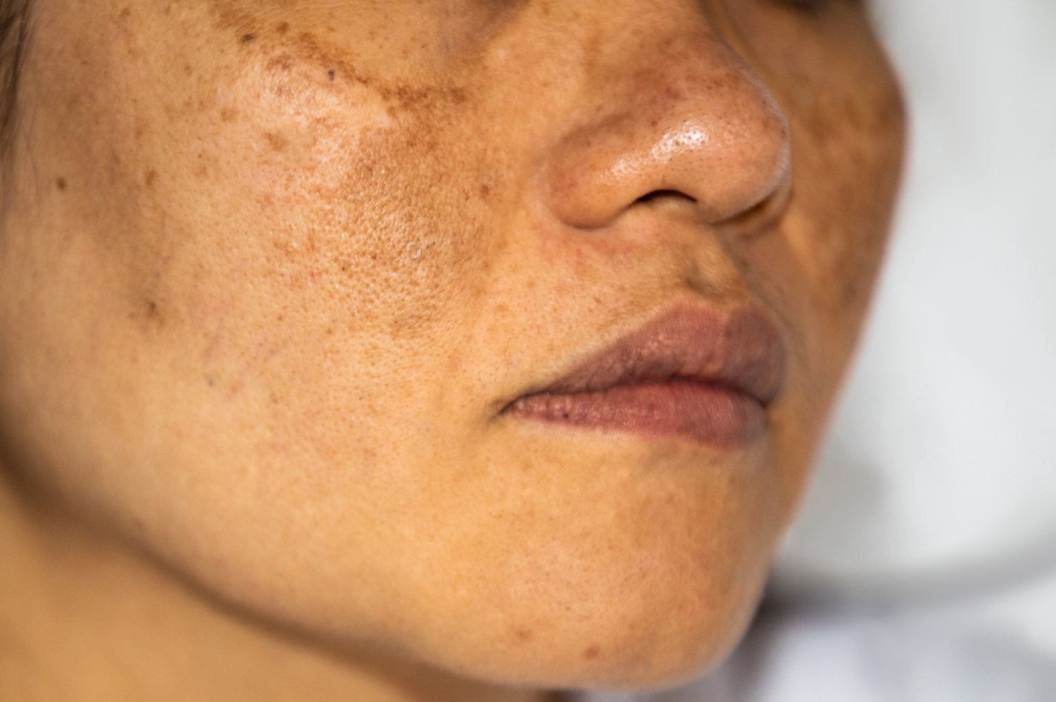 What Causes Skin Discoloration Needing Pigmentation Treatment?