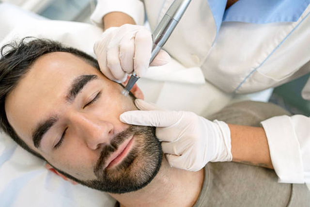 What Happens After Beard Laser Hair Removal Sessions